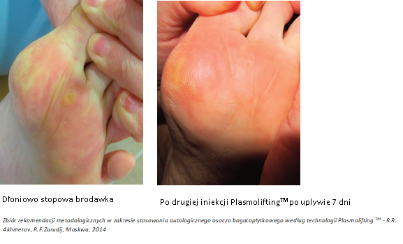 Plasmolifting Brodawla dłoniowo stopowa