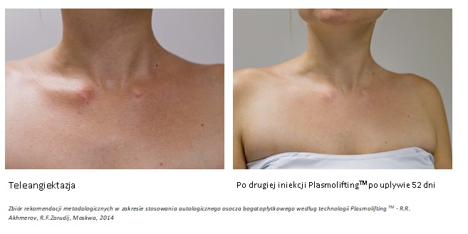 Plasmolifting Teleangiektazja